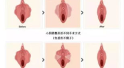 私密手术后可以肛门做吗,肛门功能与生活自理