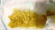 消化不良的原因有哪些,消化不良的多种成因解析